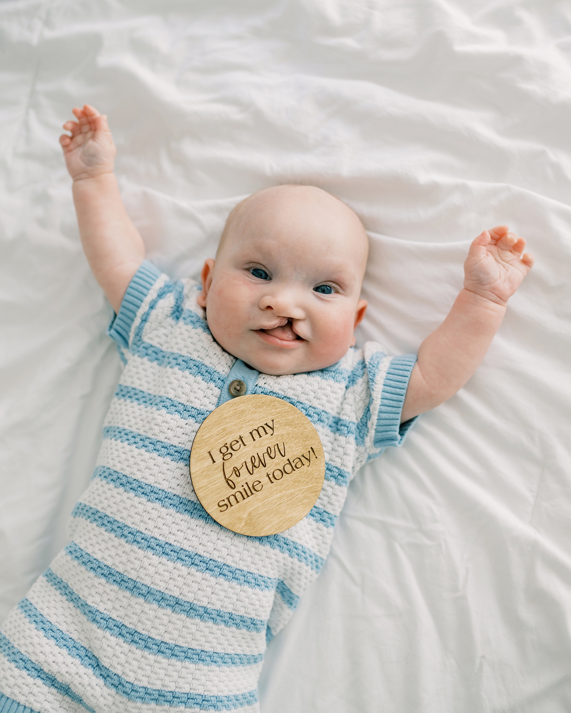 baby boy with cleft palate poses with sign that says "I get my forever smile today"